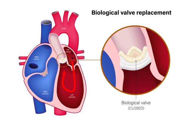 Heart Valve Replacement or Repai