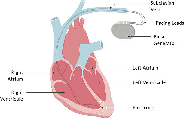 Pacemaker or ICD Implantation