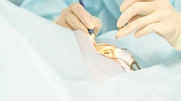 LASIK and PRK (Refractive Surgery)