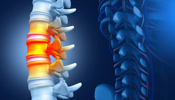 Spinal Decompression and Fusion