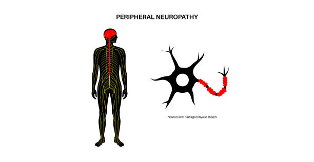 Multiple Sclerosis & Neuropathy Management
